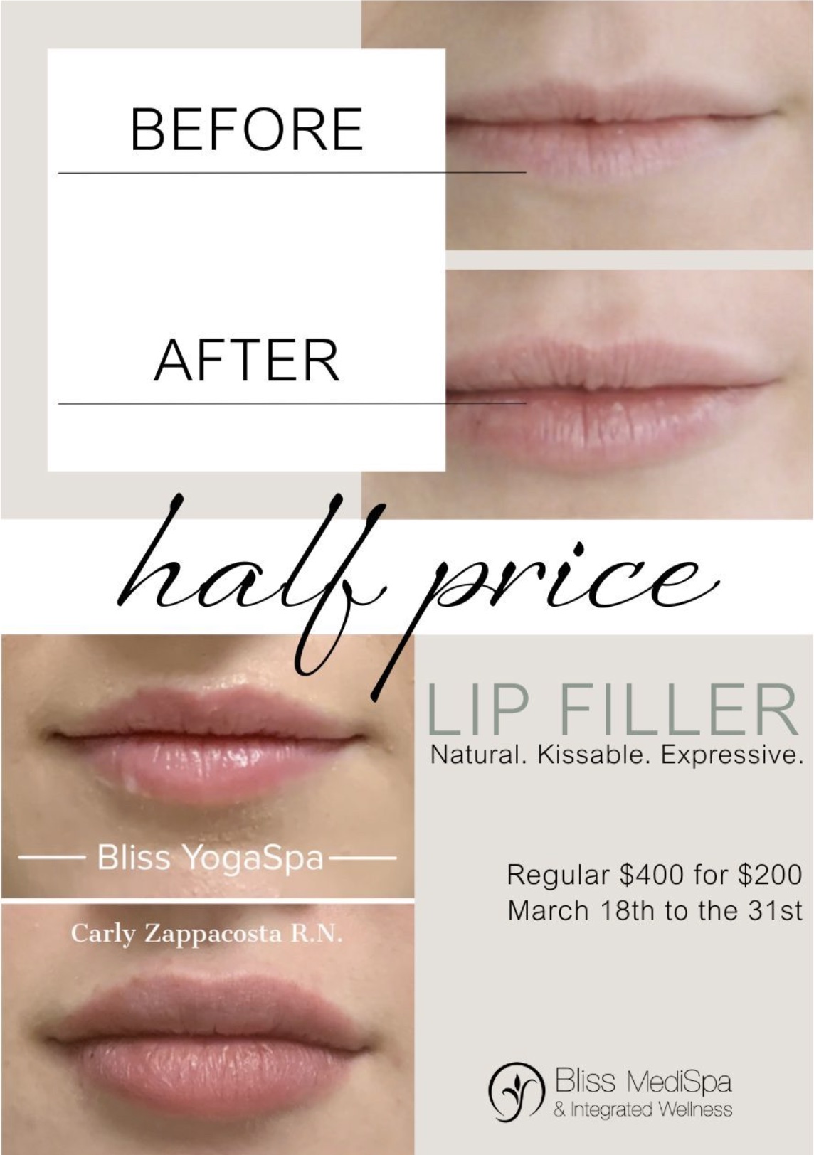 half price lip filler